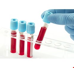 Arterial blood gas analysis 動脈血液氣體分析