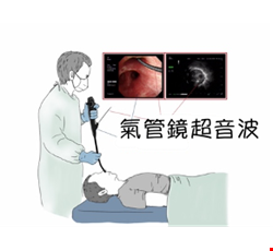支氣管鏡檢查