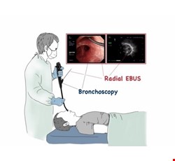 Bronchoscopy Examination 支氣管鏡檢查