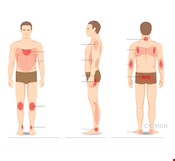 Prevention and Treatment for Pressure Injury 壓力性損傷的預防與治療