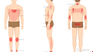 Phòng Chống Và Điều Trị Loét Tỳ Đè 壓力性損傷的預防與治療(越南文)