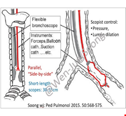Pediatric Tracheobronchial Stent Post-Operative Instructions 兒童氣管支架術後說明