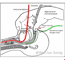Pediatric Bronchoscopy and Treatment 兒童氣管鏡檢查及治療
