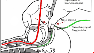 Kiểm tra nội soi và điều trị khí quản cho trẻ 兒童氣管鏡檢查及治療(越南文)