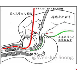 兒童氣管鏡檢查及治療