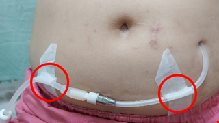 Introduction to Home Pertioneal Dialysis 認識居家腹膜透析