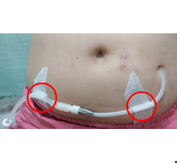 Introduction to Home Pertioneal Dialysis 認識居家腹膜透析