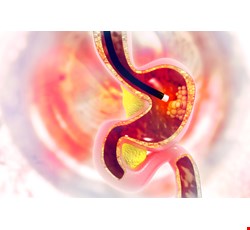 EGD in Children 兒童上消化道內視鏡檢查及治療