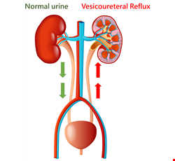 Vesicoureteral Reflux in Children 兒童膀胱輸尿管尿逆流
