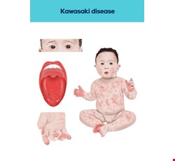Kawasaki Disease 川崎氏症