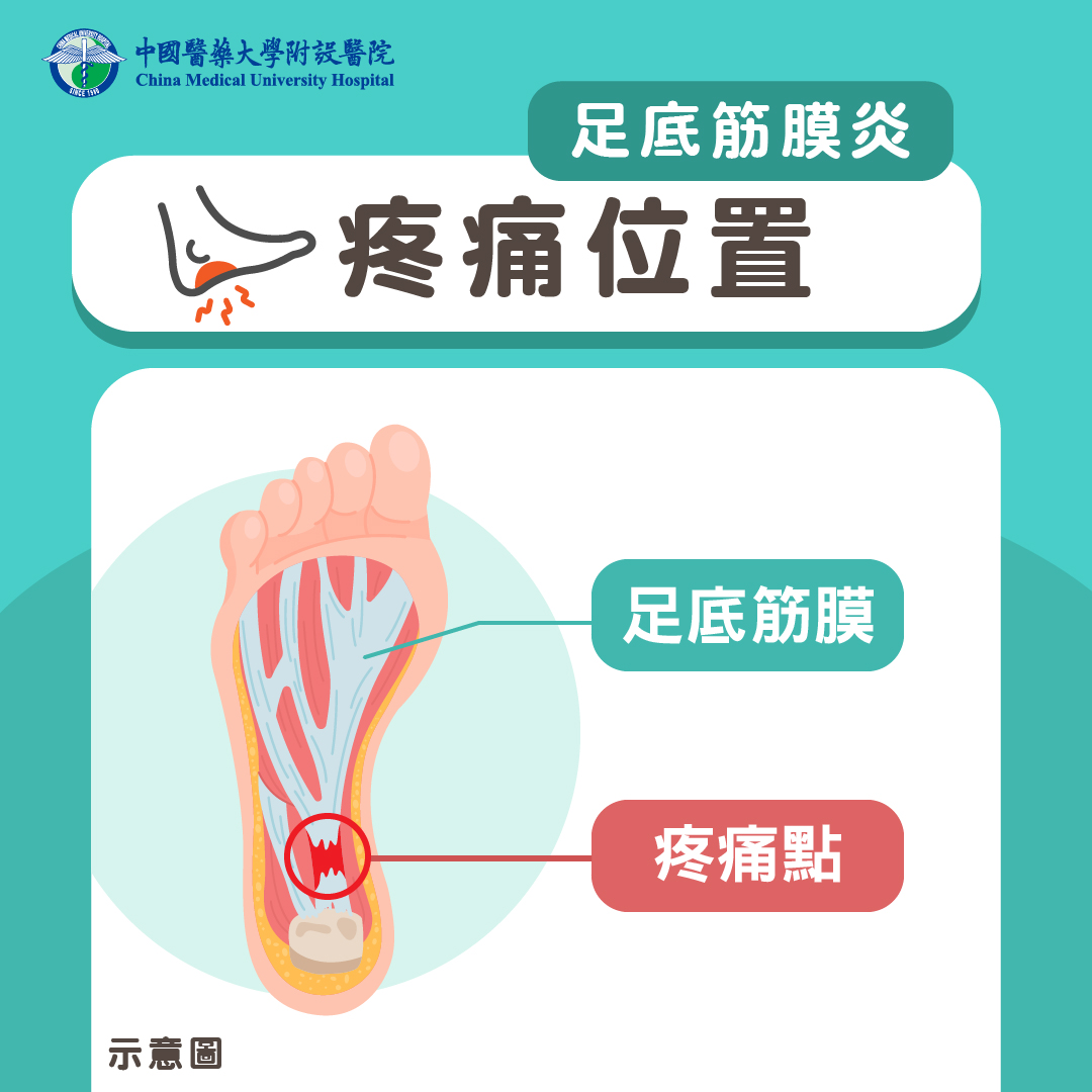 足底筋膜炎