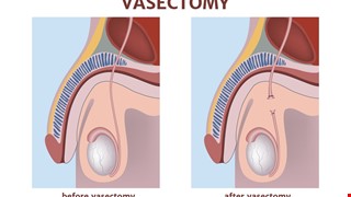 Precautions for Vasectomy 輸精管結紮注意事項