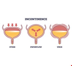 What Is Urinary Incontinence? 什麼是尿失禁？