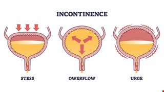What Is Urinary Incontinence? 什麼是尿失禁？