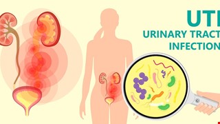 Urethritis 尿道炎