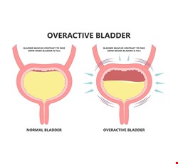 Overactive Bladder 膀胱過動症