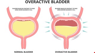 Overactive Bladder 膀胱過動症
