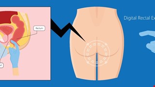 Screening for Prostate Cancer through A Digital Rectal Exam 攝護腺癌篩檢 肛門指診
