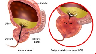 Benign prostatic hyperplasia 攝護腺肥大症