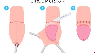 Care after Circumcision 包皮環切手術後注意事項