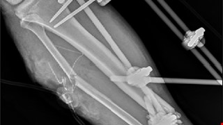 Nursing Care of External Fixation Devices 裝置骨外固定器照護