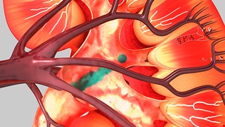 Care for Kidney Donors 捐腎者照護要點