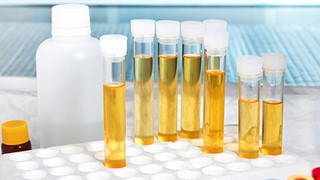 Air Bubbles in the Urine 小便起泡泡談起