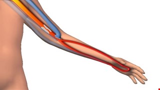 Arteriovenous Fistulas in Dialysis Patients 洗腎病人之動靜脈瘻管介紹