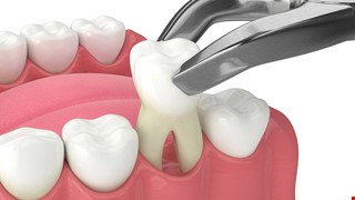 Post-extraction Care Instructions 拔牙手術後病人之注意事項