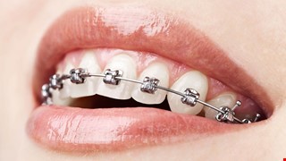 Notes for Orthodontic Patients 齒顎矯正病人注意事項