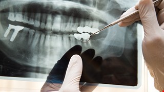 Health Education Instructions After Dental Bone Screw and Bone Plate Fixation 牙科骨釘骨板術後衛教