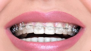Notes before Orthodontic Treatment 齒顎矯正治療前之注意事項