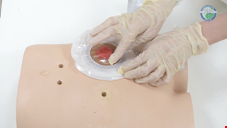 Enterostomy Supplies and Devices 腸造口用品裝置方法