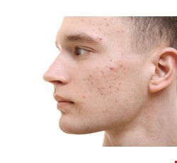 Acne Skincare 痤瘡皮膚保養