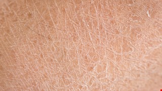 Winter Eczema 冬季濕疹