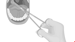 Tonsillectomy 扁桃切除術