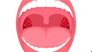 淺談急性扁桃腺炎