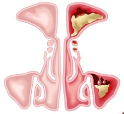 Rhinosinusitis 鼻竇炎