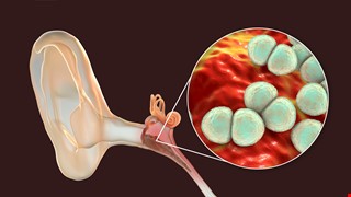Operative Precautions for Otitis Media 中耳炎手術與注意事項