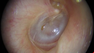 Serous Otitis Media 漿液性中耳炎