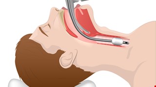 Laryngomicrosurgery (LMS) 喉部顯微手術介紹