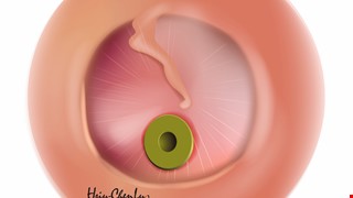 Postoperative Health Education Instructions for Middle Ear Ventilation Tube Insertion 中耳通氣管置放術後衛教說明