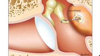Postoperative Health Education Instructions for Ossicular Implants 人工聽小骨手術後衛教說明
