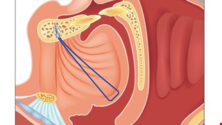 Postoperative Health Education Instructions for Tongue Suspension Sutures 舌根懸吊手術後衛教說明