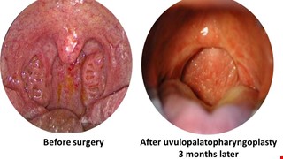 Snoring and Sleep Apnea Syndrome 打鼾與睡眠呼吸中止症候群