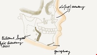 正顎手術術後衛教Orthognathic surgery