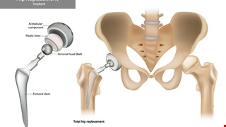 Getting to know Artificial Hip Joint Replacement Surgery 認識人工髖關節置換術