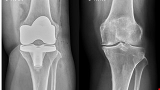 Degenerative Joint Disease and Joint Replacement 退化性關節炎與關節置換