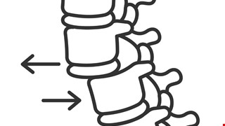 Spondylolisthesis 脊椎滑脫
