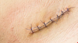 Instruction for Orthopedic Wound Care 骨科傷口照護注意事項